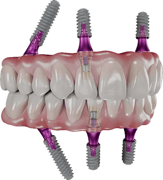 Bredent SKY implant üstü protetik